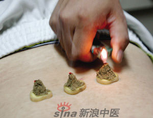 灸法的種類  你知道多少？